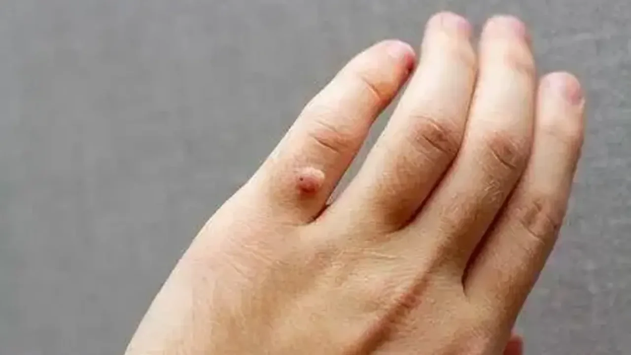 Geçmişten Günümüze Siğil Tedavisinde Okunan Dualar ve Yöntemleri